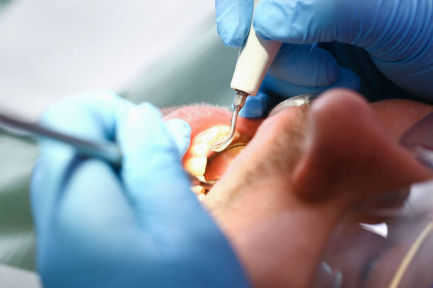Best Emergency Wisdom Teeth Removal in Crainvle, IL