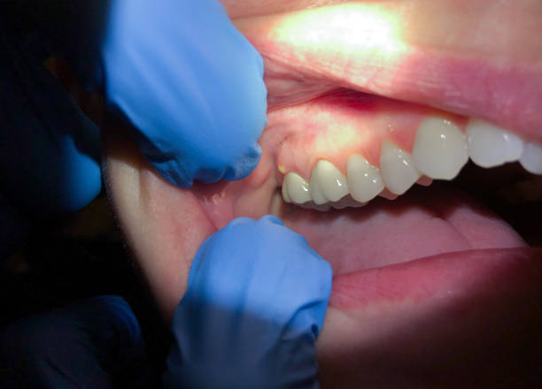 Best Emergency Tooth Extraction in Crainvle, IL
