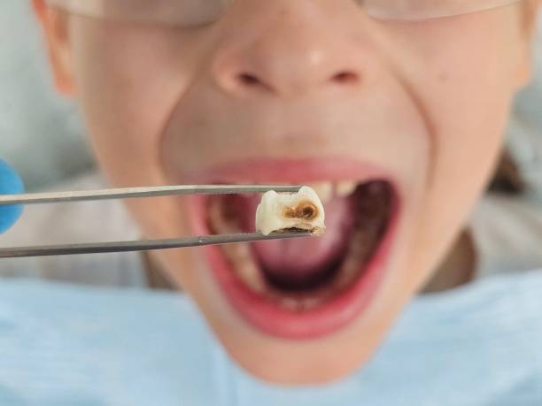 Best Emergency Treatment for Dental Infections or Abscesses in Crainvle, IL